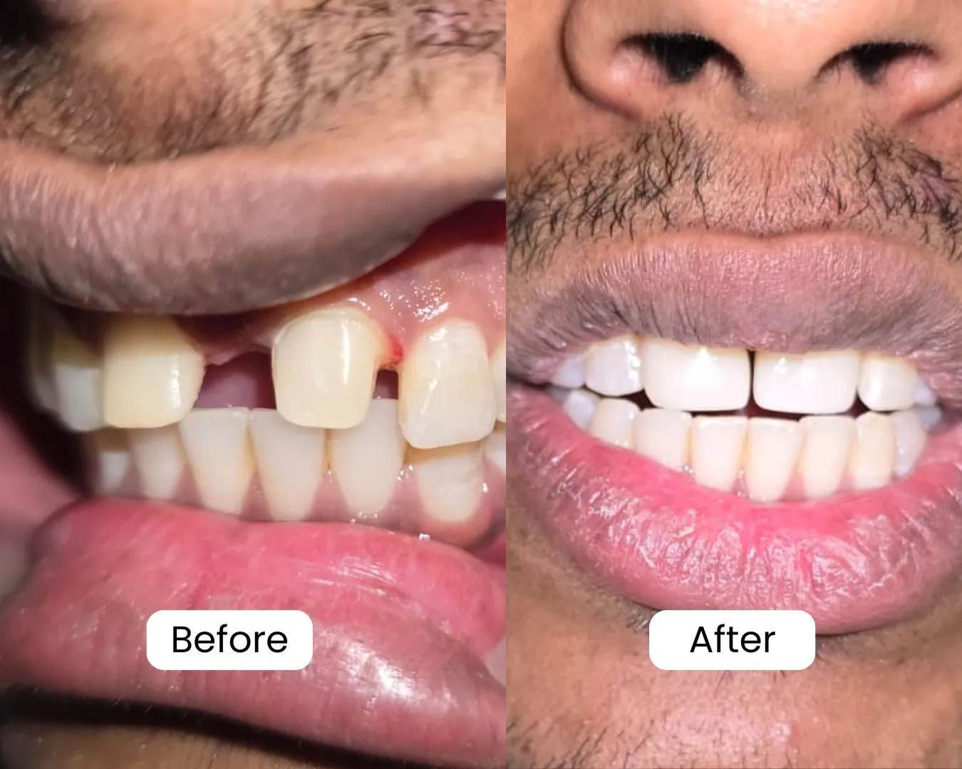 Patient before and after result 14