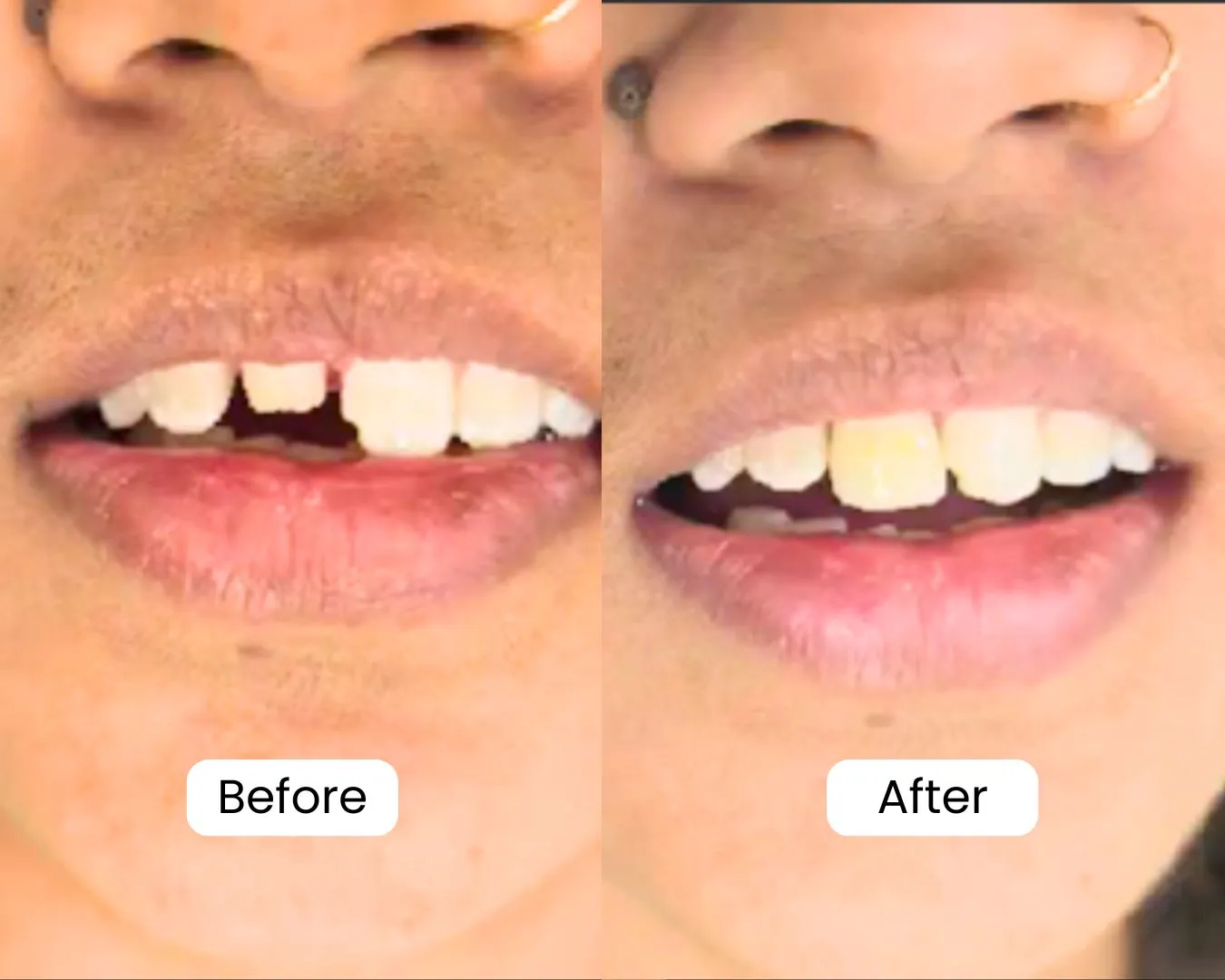 Patient before and after result 15