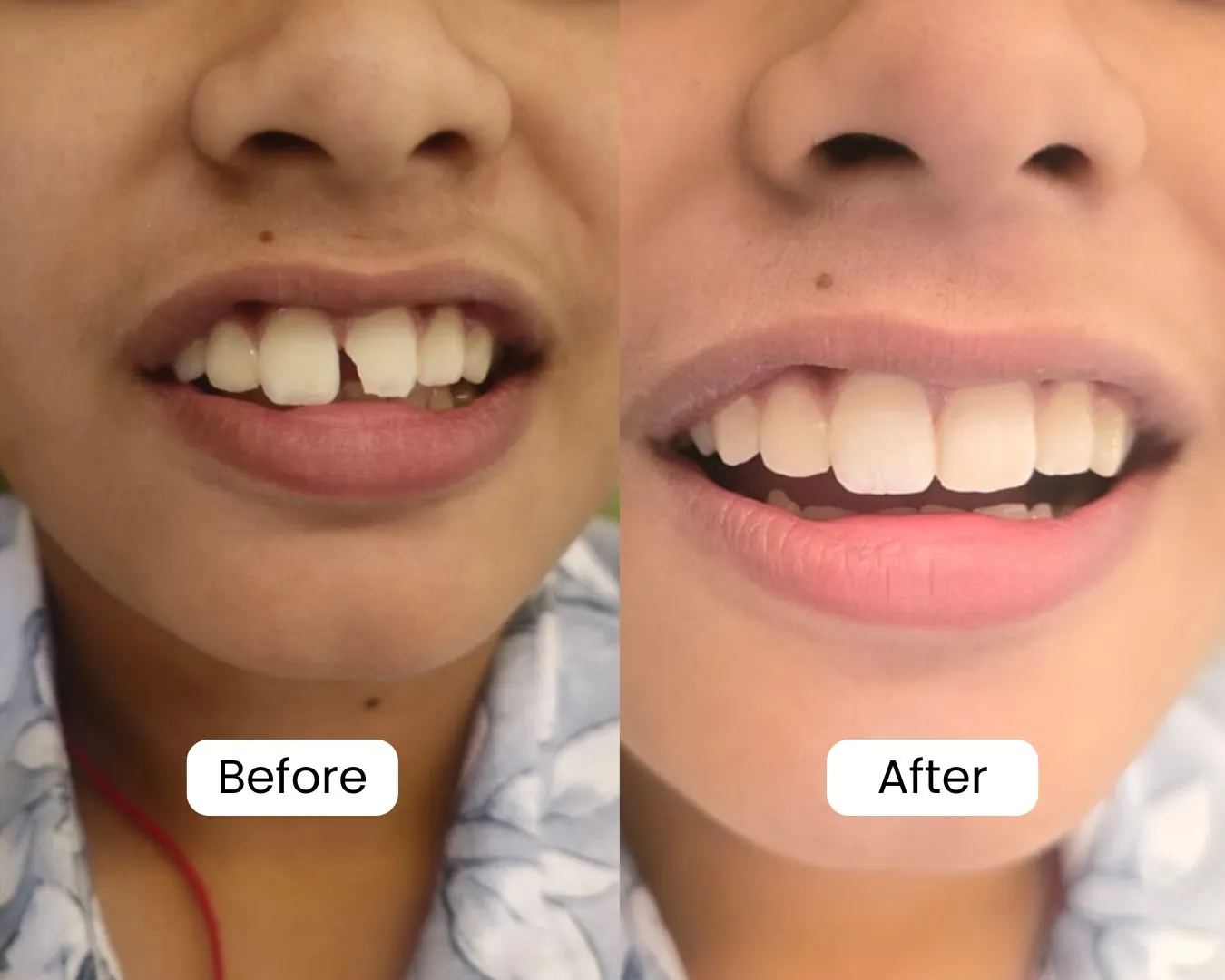 Patient before and after result 16