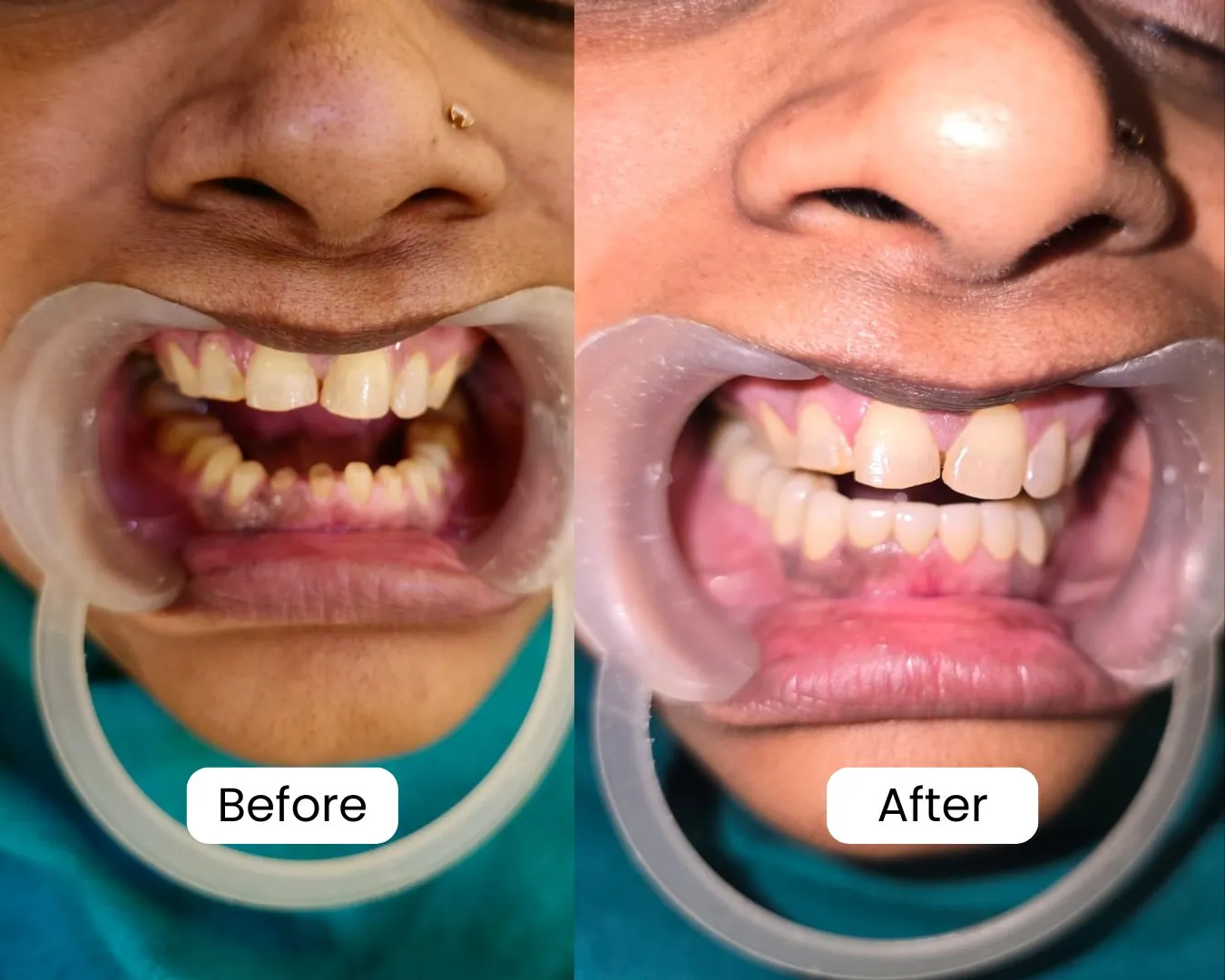 Patient before and after result 18