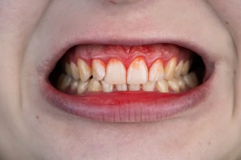 Bleeding Gums — causes and treatment in Varanasi