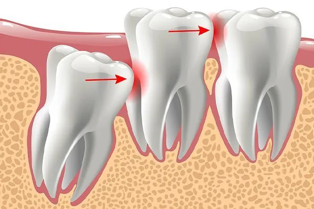 Wisdom Tooth Removal in Varanasi